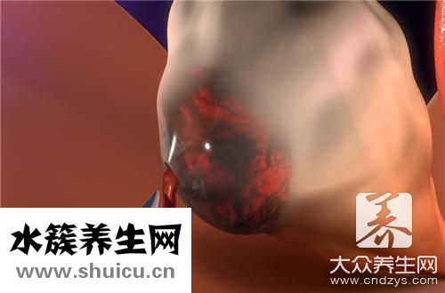 巧克力囊腫復發