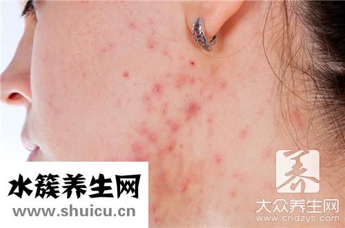 起痘痘位置對照內臟