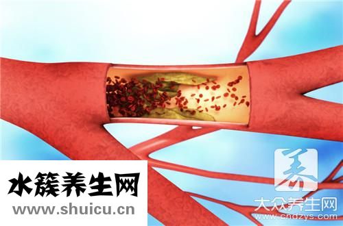 腦血管堵塞吃什么好