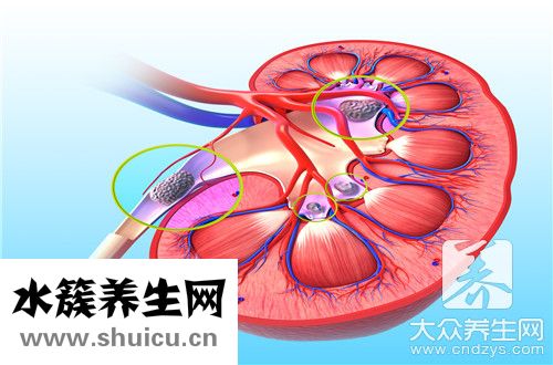 腎結(jié)石是什么引起
