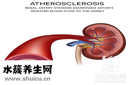 動脈瘤手術后能活多久
