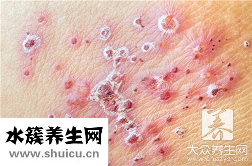 脫敏針一針多少錢