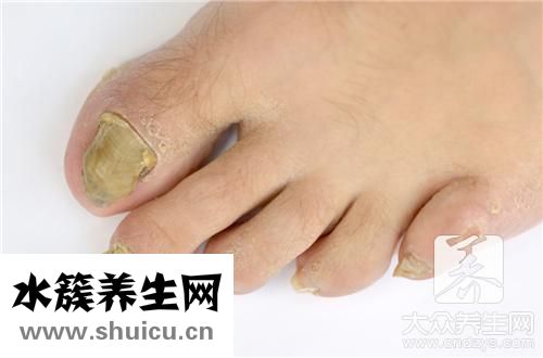 灰指甲竟然自己好了