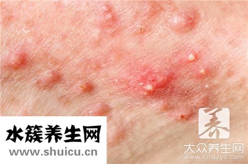 臉頰兩側長痘內調