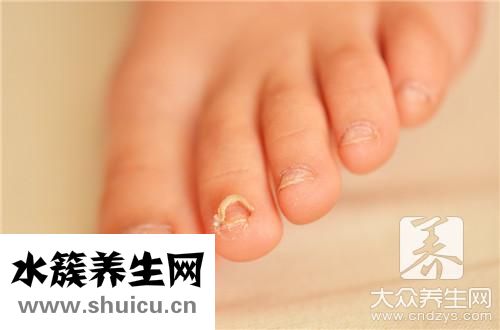 灰指甲竟然自己好了