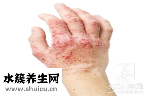 跳蚤咬了止癢最快