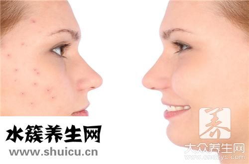 臉頰兩側長痘排毒