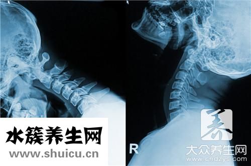 頸椎骨質(zhì)增生根除