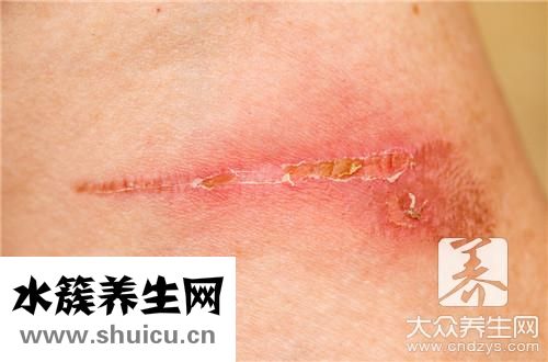 紅色疤痕一般多久消失