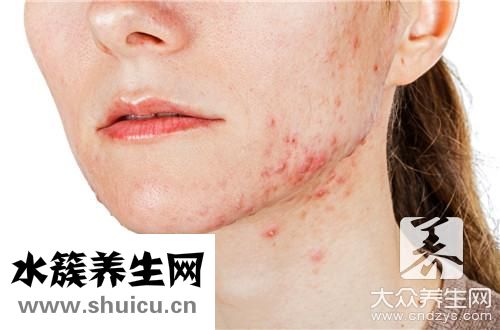 下巴老是長痘痘