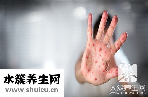 手部濕疹和手癬區別