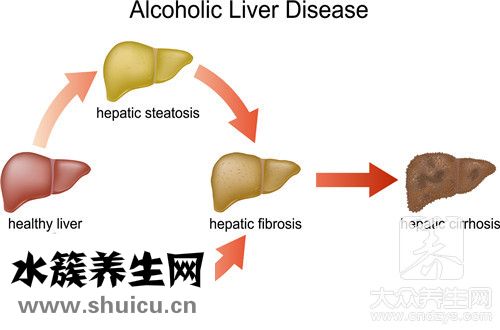 膽汁淤積性肝病