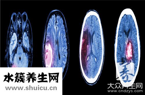 腦積水有哪些癥狀