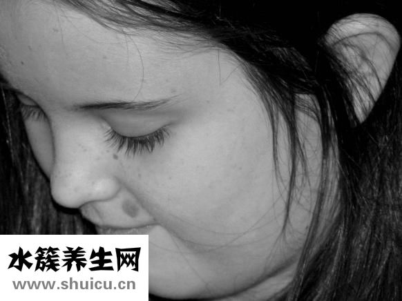 腺樣體面容圖片