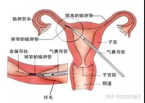 輸卵管堵塞的10個(gè)征兆，輸卵管堵塞的10個(gè)征兆在哪廣州南粵怎么找呢