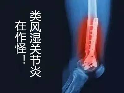 類風濕關節炎早期癥狀，類風濕關節炎早期癥狀有哪些