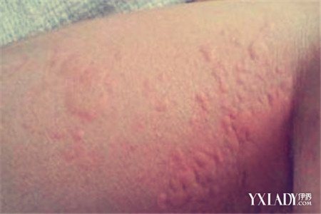 皮膚過敏的真實圖片女士臉部（皮膚過敏的真實圖片）