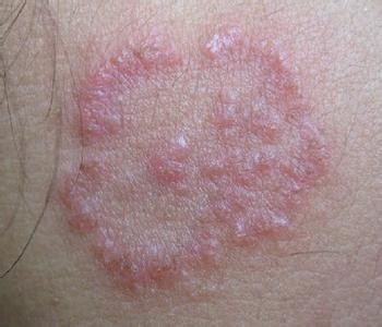 頭皮神經性皮炎的癥狀表現（神經性皮炎的癥狀表現）