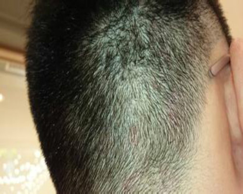 皮膚真菌感染的圖片（各種癬的癥狀圖片及名稱）