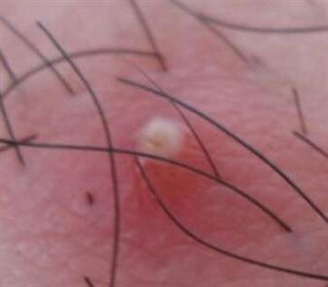 臉上毛囊炎怎么治才能除根（毛囊炎怎么治才能除根）