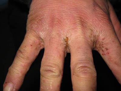 疥瘡早期癥狀的圖片（疥瘡早期癥狀圖片介紹）