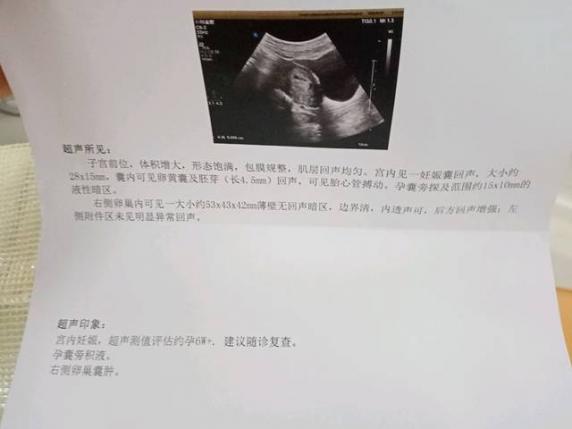 卵巢囊腫的癥狀是什么樣的（卵巢囊腫的癥狀10大前兆）