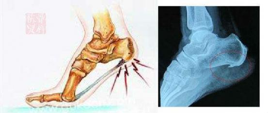 腰椎體骨質增生怎么治療能根除（骨質增生怎么治療能根除）