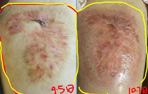 隱私左側長了個軟疙瘩是怎么治（隱私左側長了個硬疙瘩是怎么治）