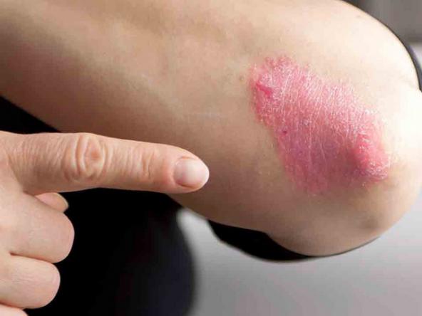 女性銀屑病初期圖片頭皮（女性銀屑病初期圖片）