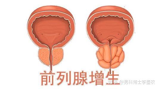前列腺增生自我治療方法有哪些（前列腺增生自我治療方法）