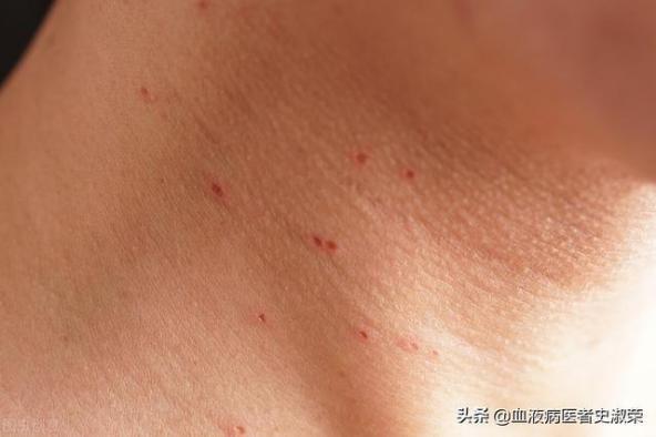 兒童過敏性紫癜的癥狀(過敏性紫癜的癥狀)