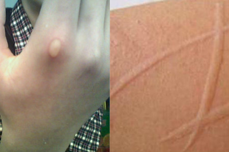 風(fēng)疹癥狀圖片及病因是什么（風(fēng)疹癥狀圖片及病因）