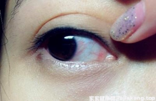 角膜炎快速好的辦法是什么（角膜炎快速好的辦法）