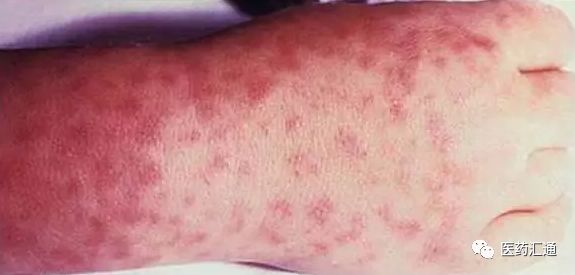 男性怎么判斷自己得性疾病了（如果感染性疾病多久才會有癥狀）