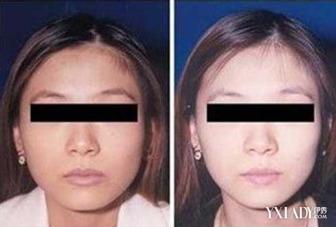 打瘦臉針的利和弊（打瘦臉針的危害及后期副作用）