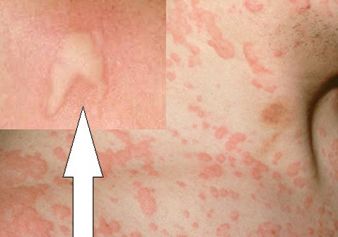 濕疹圖片和癥狀圖片（麻疹圖片和癥狀圖片）