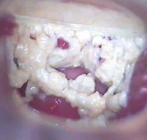 兒童霉菌性陰炎怎么根治（霉菌性陰炎怎么根治）