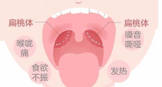 扁桃體發炎2分鐘消炎吃什么藥（扁桃體發炎2分鐘消炎）