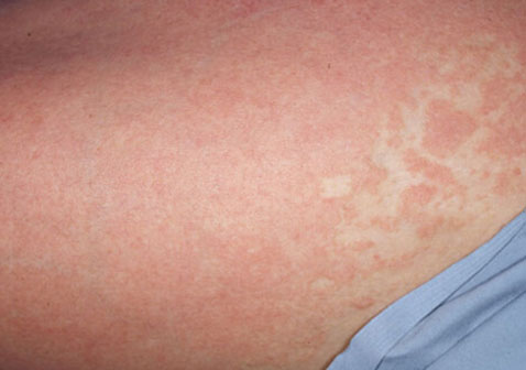 點狀牛皮皮癬原因（點狀牛皮皮癬早期癥狀圖片）