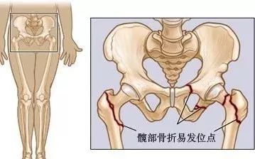 骨頭壞死了還能恢復嗎（骨頭壞死了還能恢復嗎中醫）