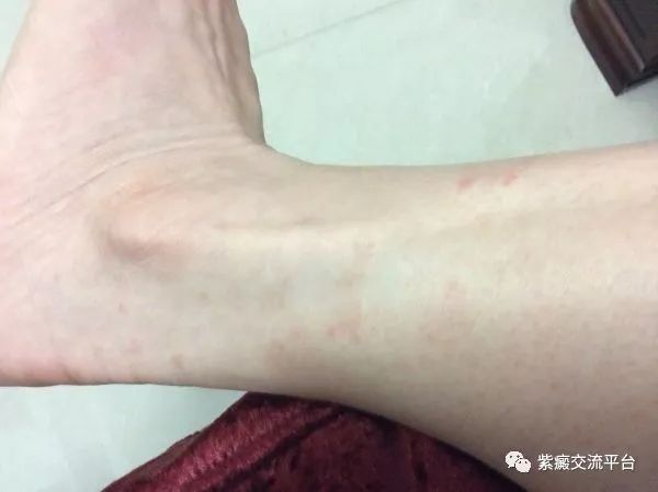 紫癜是一種什么病(紫癜是一種什么病嚴重嗎)