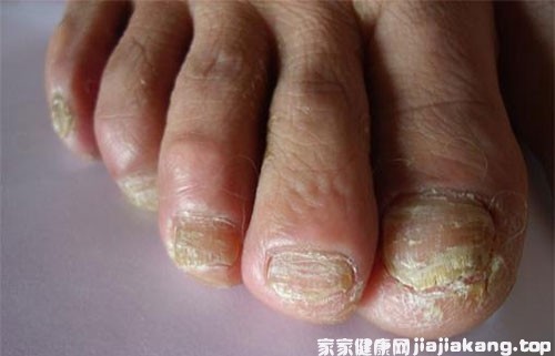 腳氣真菌感染用哪些藥最好(腳氣真菌感染吃什么藥最好)