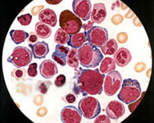 血小板增多癥能治好嗎（基因突變血小板增多癥能治好嗎）