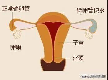 怎么判斷自己得了盆腔炎(盆腔炎用什么藥效果最好)