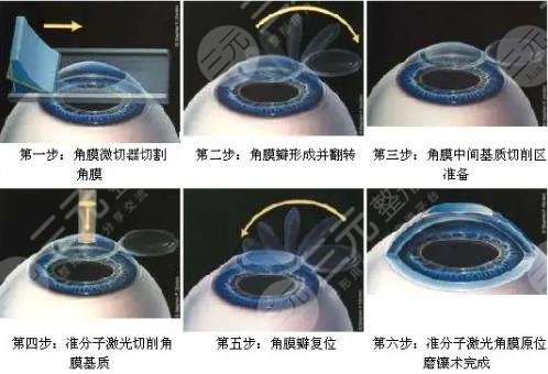 眼睛手術(shù)費(fèi)用一覽表（眼睛手術(shù)費(fèi)用一覽表北京同仁眼科醫(yī)院地址）