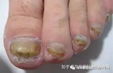 灰指甲用手摸了會傳染嗎（灰指甲手摸過的東西有真菌嗎）