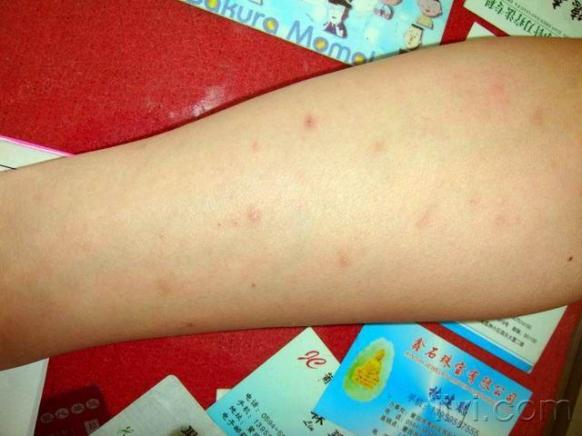 治療疥瘡最快最有效的辦法（疥瘡和濕疹的區別圖）