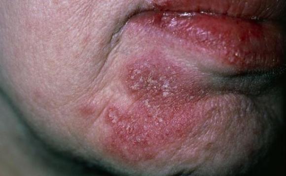 紅斑狼瘡病人最大壽命（紅瘡狼斑怎么引起的）