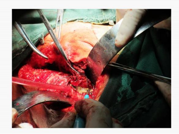 肛瘺圖片清晰圖(不用開刀治肛瘺有四種方法)