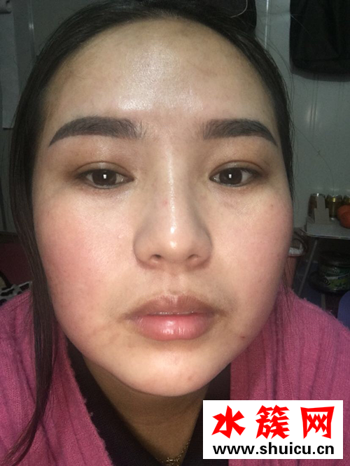 怎樣祛斑？激光祛斑后悔死了